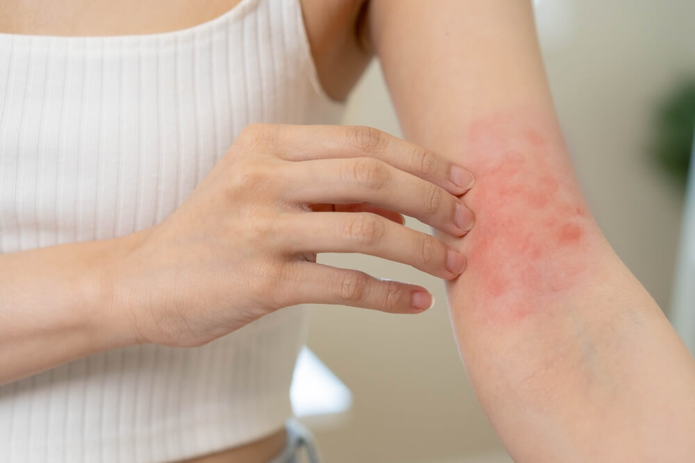 5 Langkah Ampuh Mengatasi Alergi Kulit Secara Alami